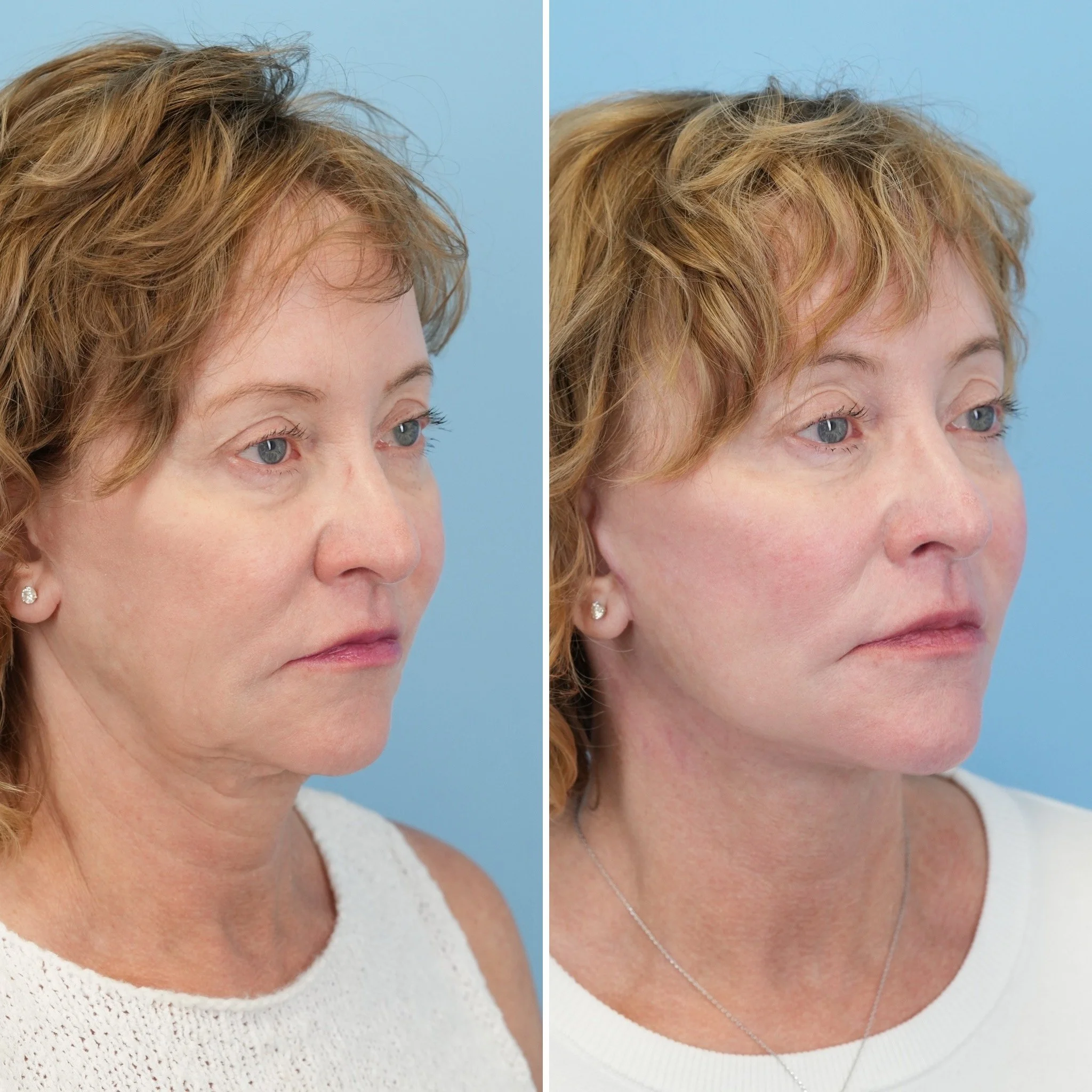 facelift 4.JPG