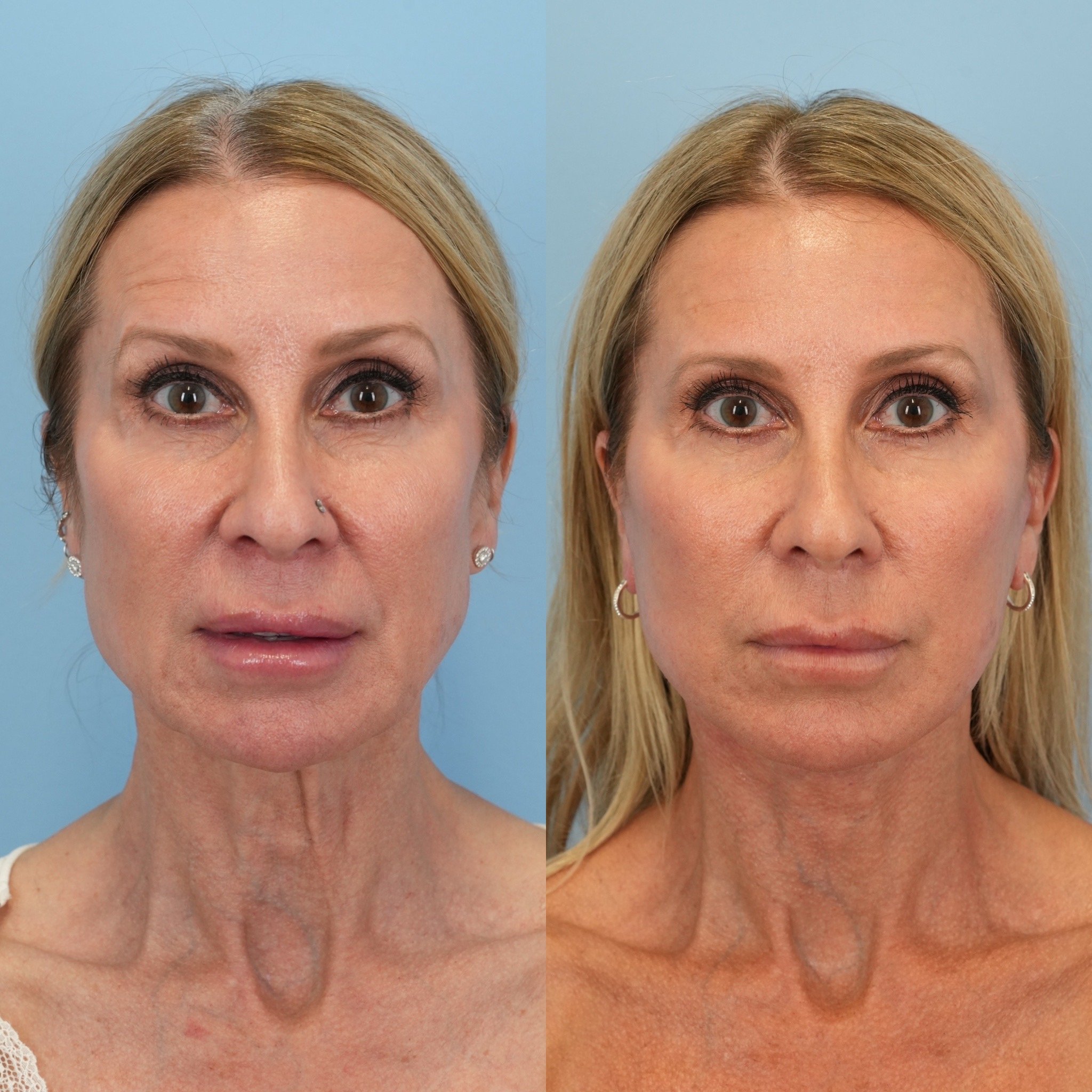 face and neck lift.JPG