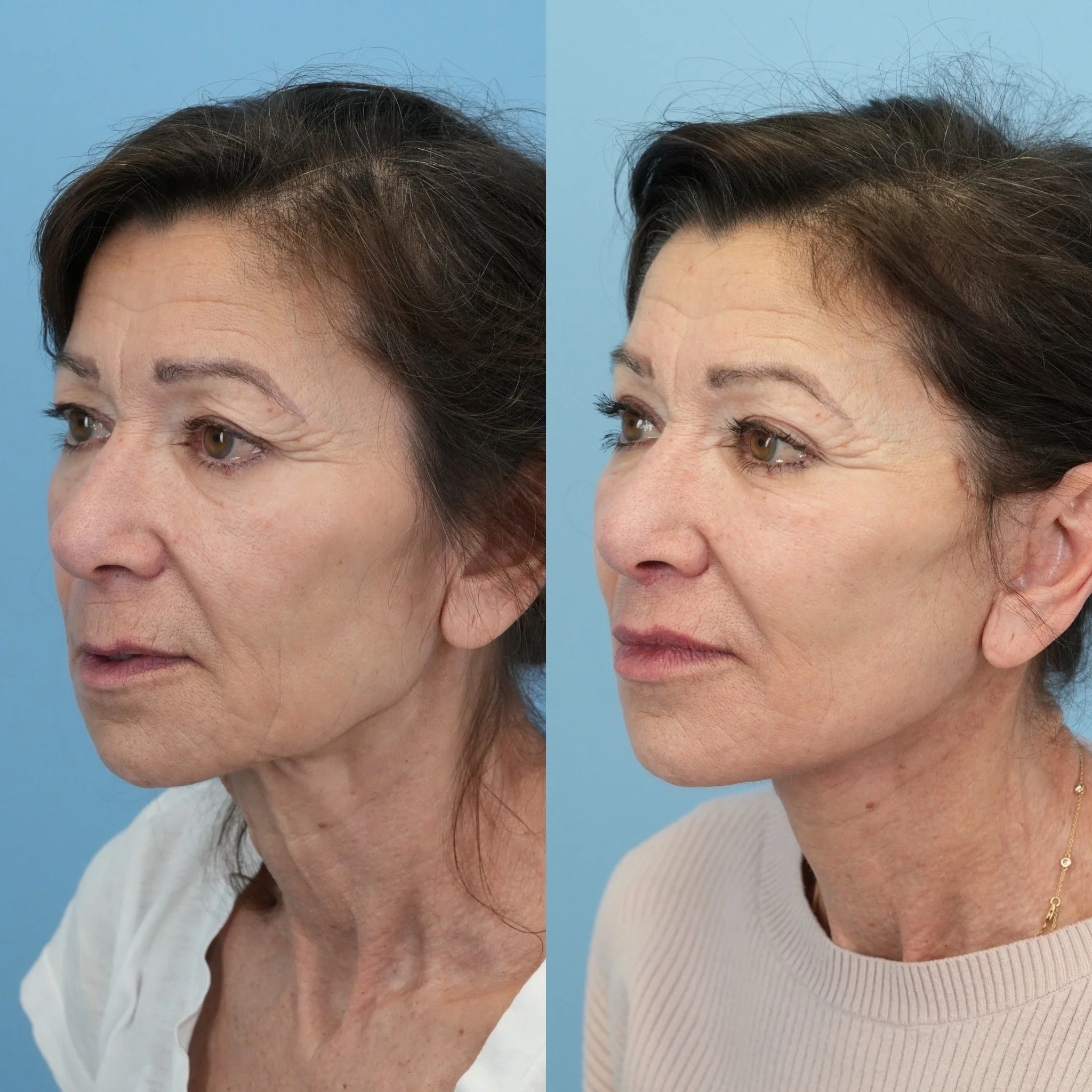 facelifttt.JPG