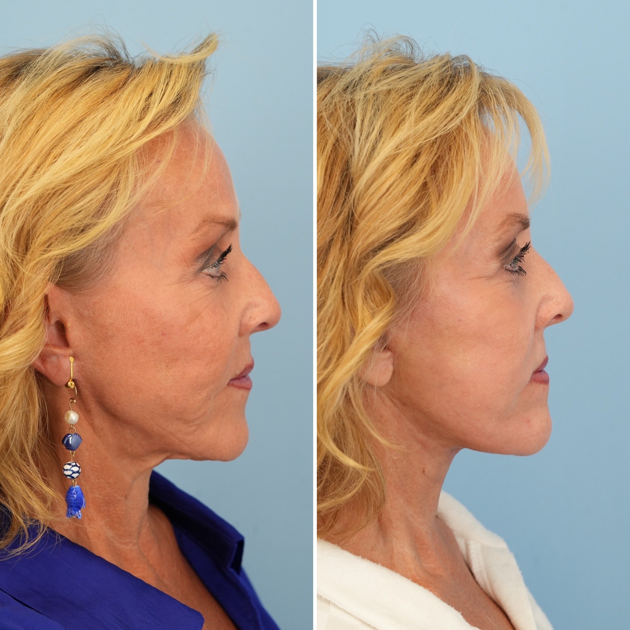 facelift 3.JPG
