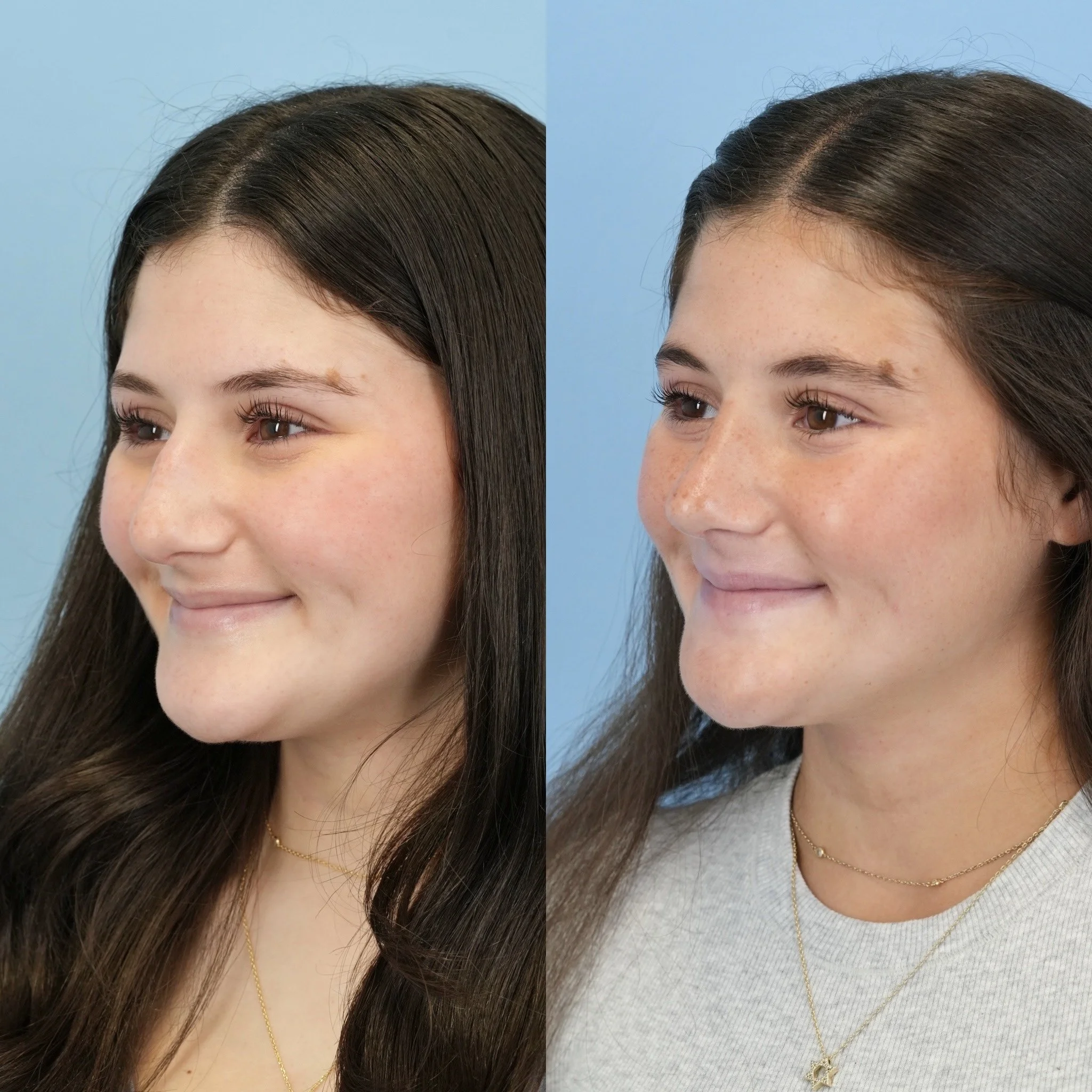 rhinplasty.jpg