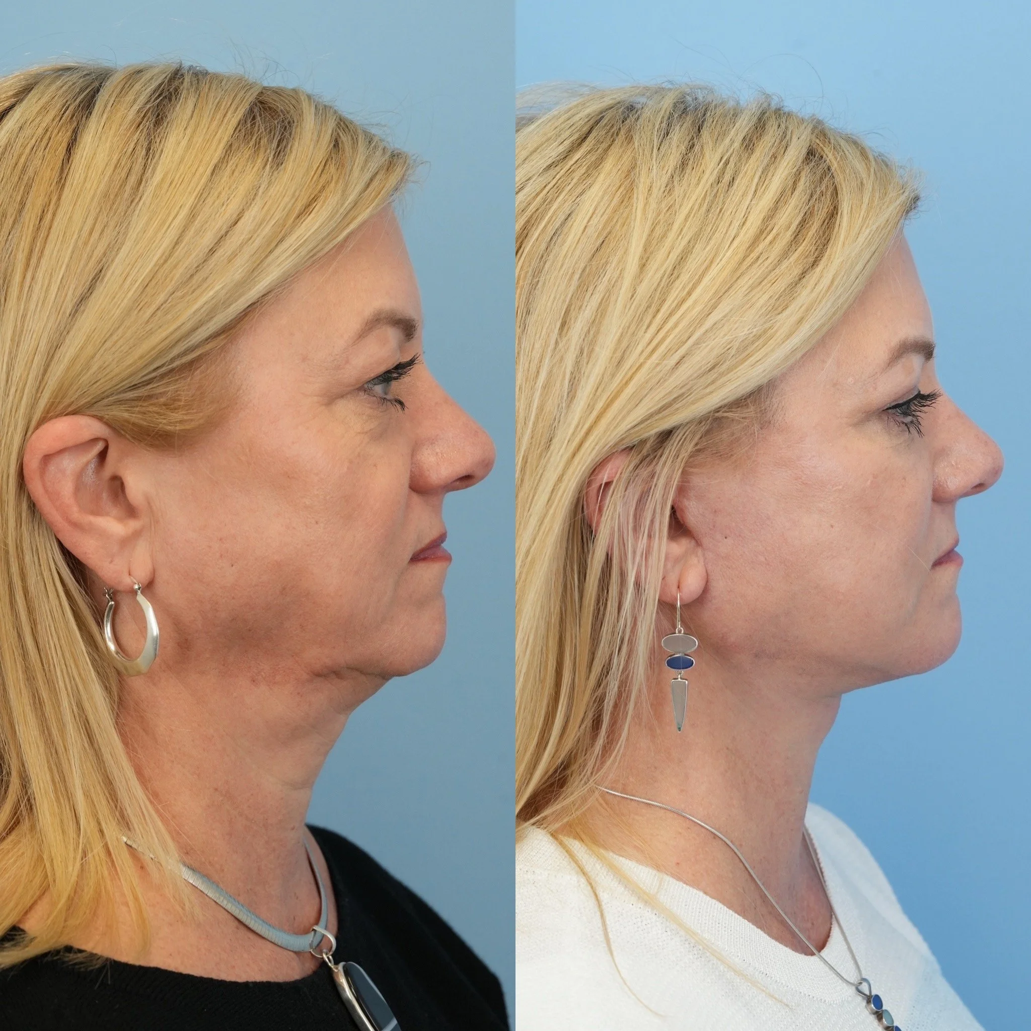 faceliftttt.JPG
