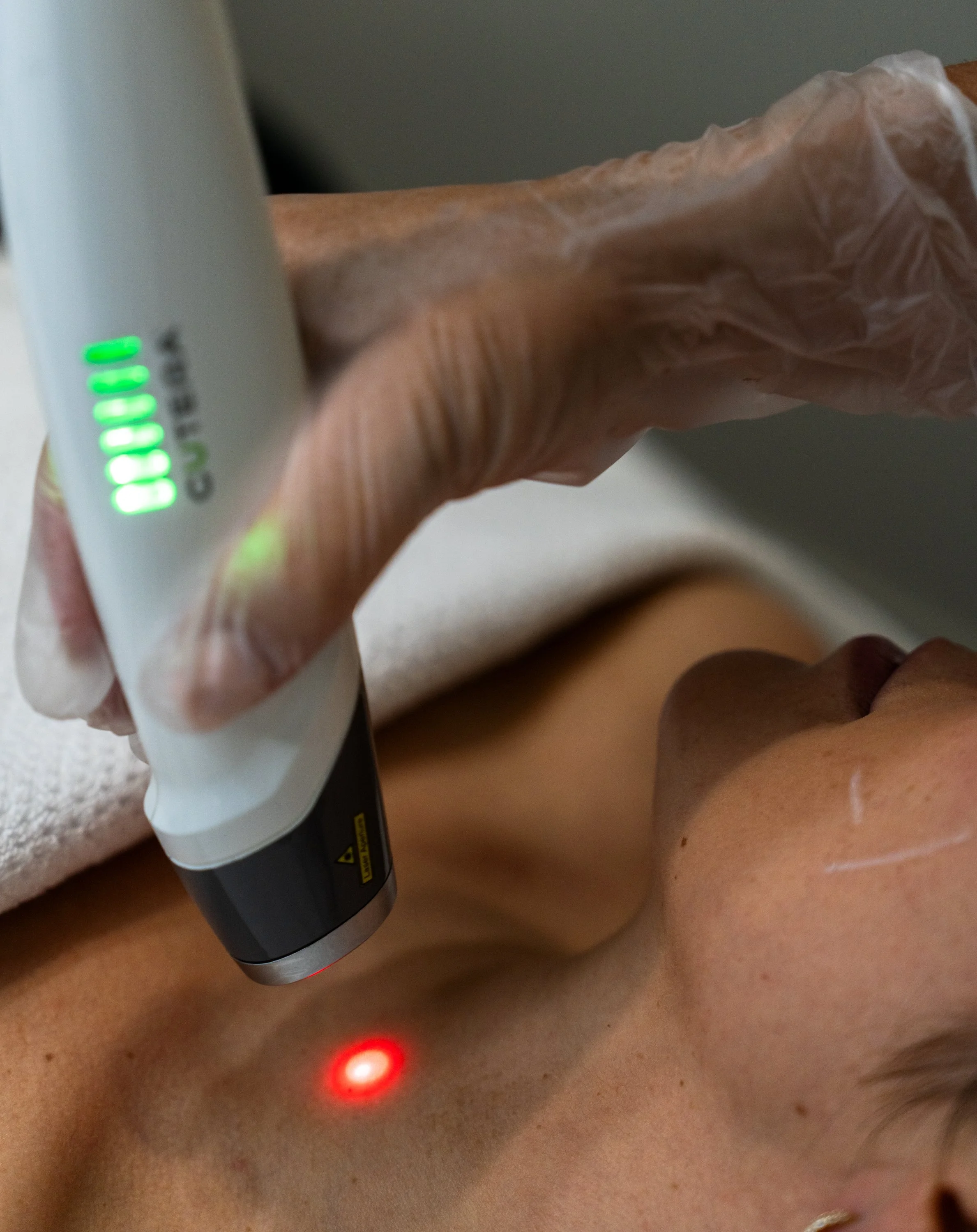 Cutera Laser Genesis