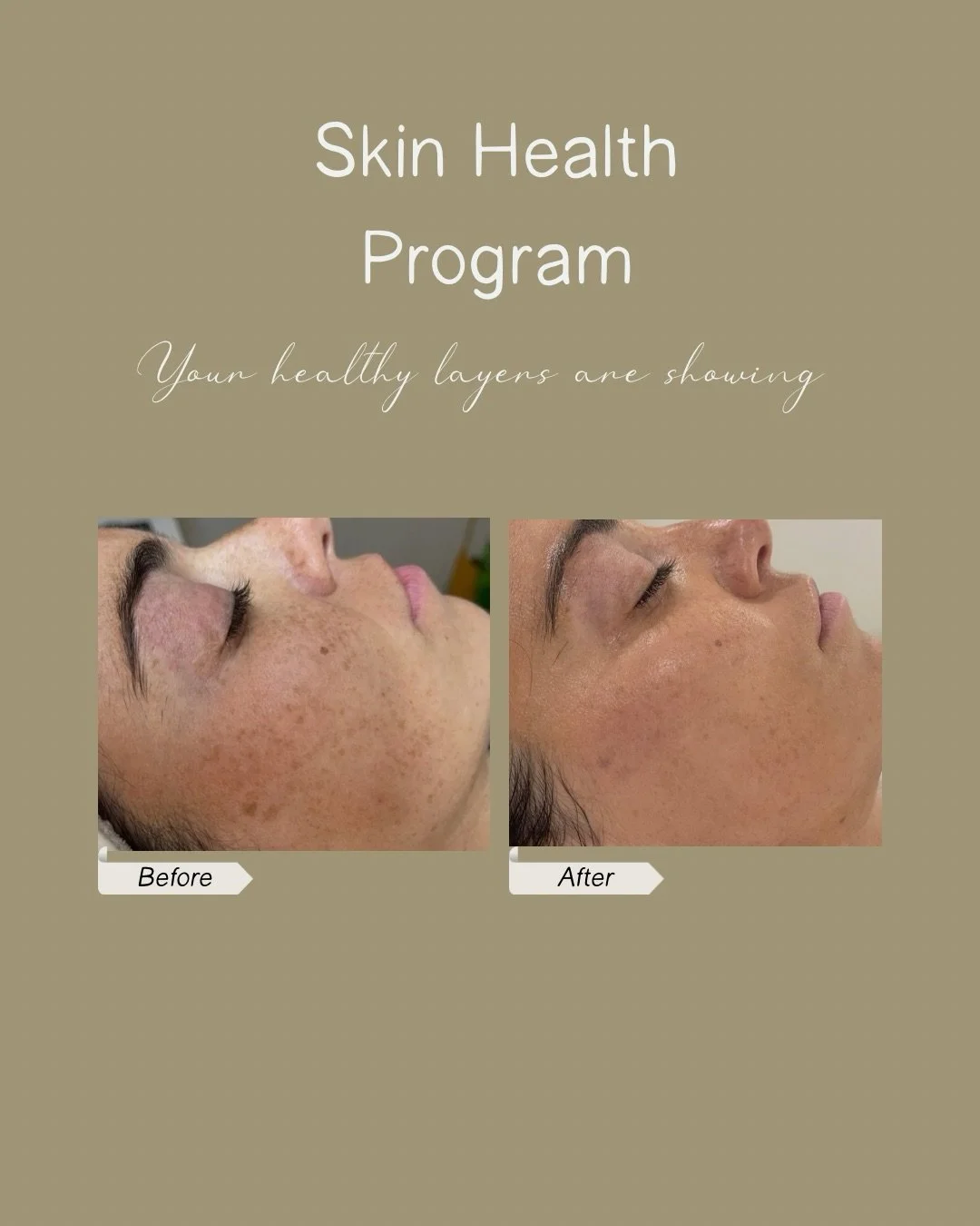 Melasma is not a quick fix
and it should never be treated like one

This is a process
not suppression

Book your plan in link in Bio 🔗