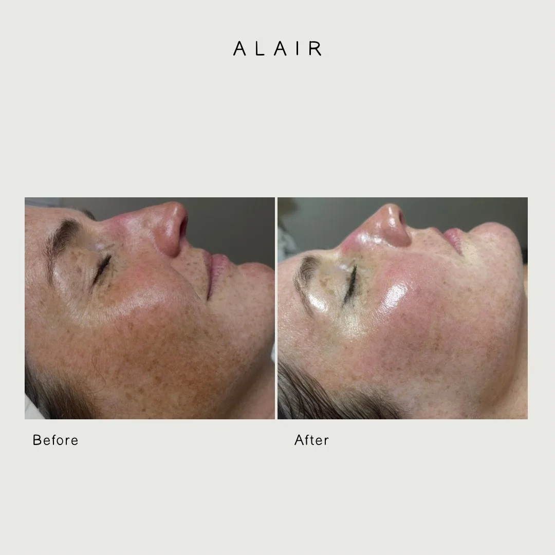 I took this client slow intentionally. She wanted a brighter, more even appearance, but I wanted to preserve the uniqueness of her skin. That was important to me. The goal is never to erase who someone is, just create healthier, stronger, more balanc