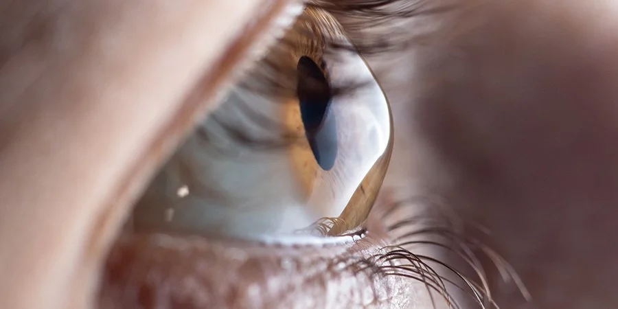 šļø Understanding Keratoconus and the Role of Scleral Lenses