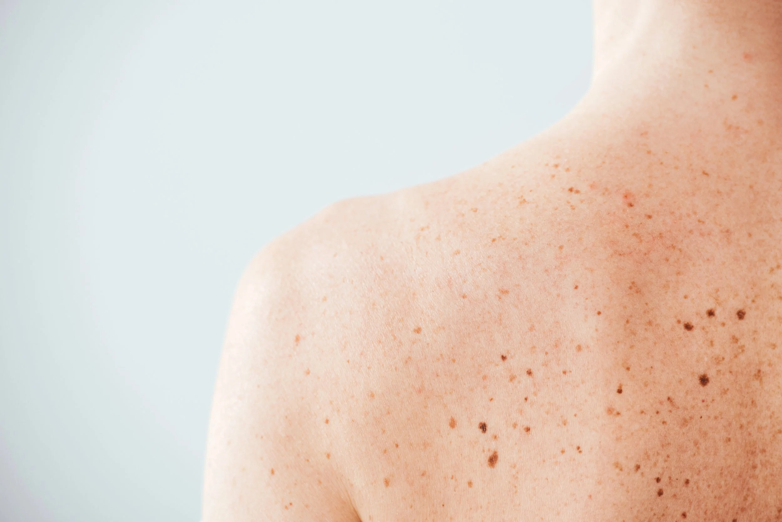 Close-up of a person’s upper back and shoulder showing light skin with multiple freckles and moles against a pale background.