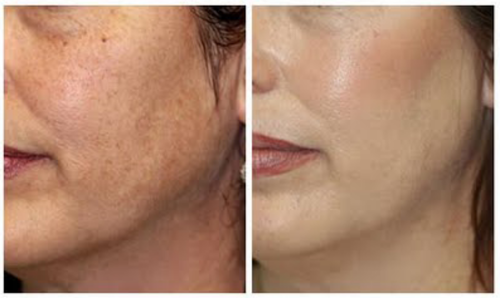 Wrinkle removal and skin tightening - Salmon DNA