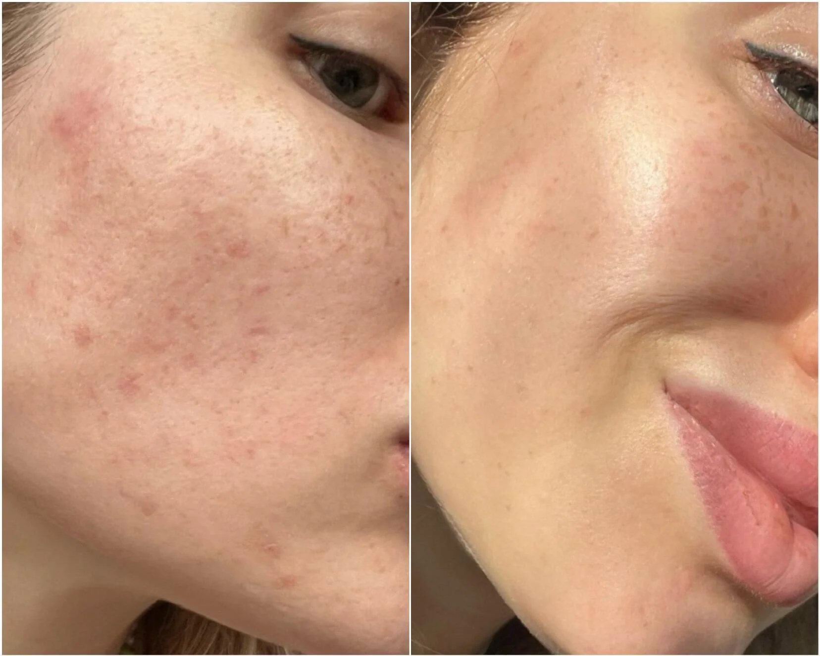 Porovnanie tváre klientky pred a po kozmetickom ošetrení v kozmetickom salóne Olyva Beauty v Bratislave, zlepšenie pleti a redukcia pigmentových škvŕn a jazvičiek po akné.