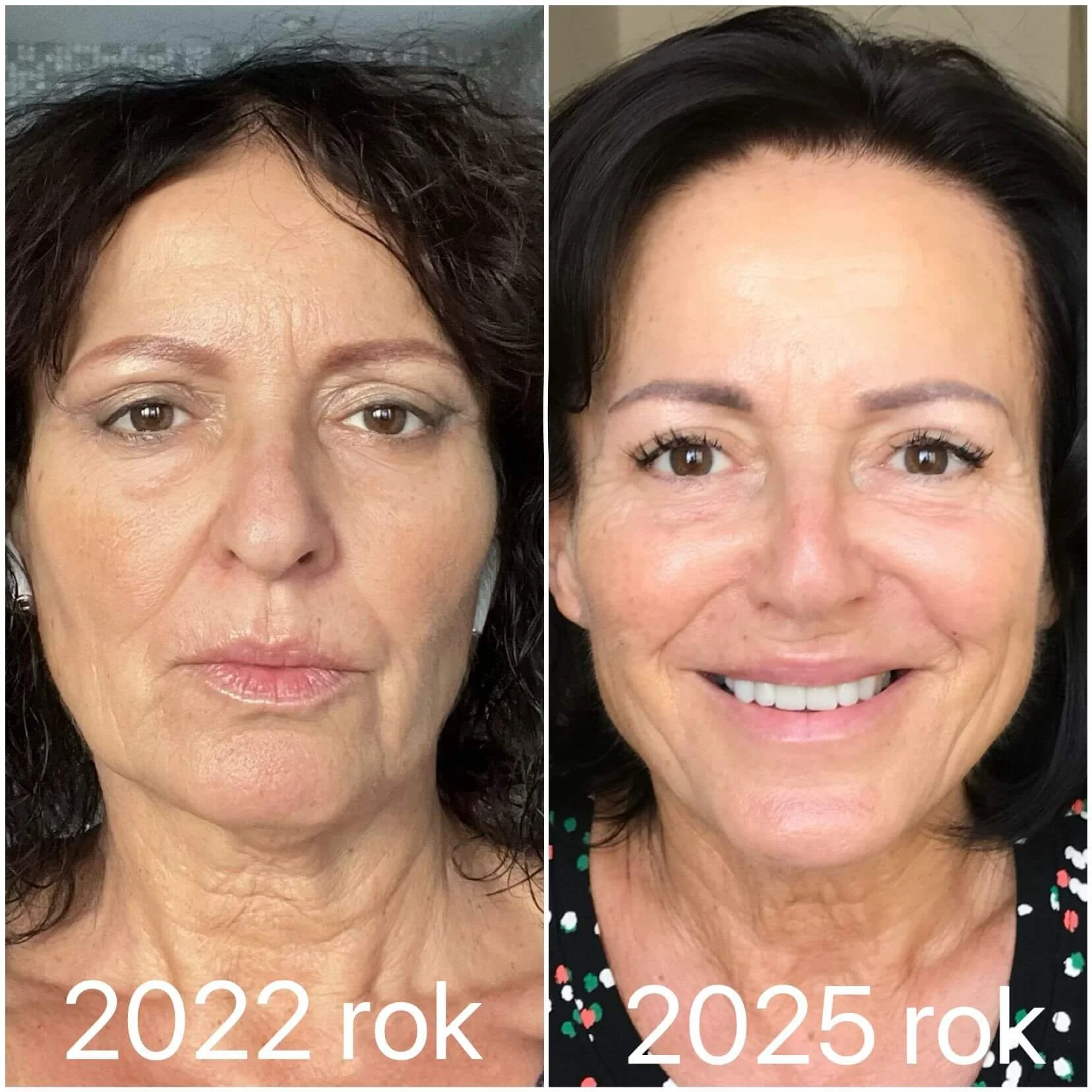 Pred a po kozmetickom ošetrení v salóne Olyva Beauty Bratislava – zlepšená pleť a spokojná klientka.