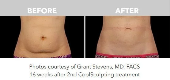 Comparison of a person's abdomen before and after CoolSculpting treatment, showing reduced area and a scar in the after photo.