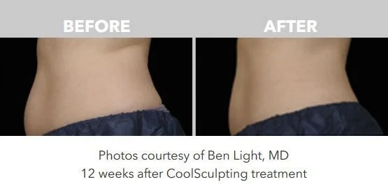 Comparison of a woman's waist before and after CoolSculpting treatment, showing a slimmer waist in the after photo.