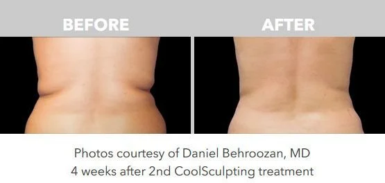 Comparison of back skin before and after CoolSculpting treatment showing reduction in fat and skin tightening.