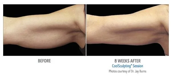Comparison of a person's upper arm before and 8 weeks after CoolSculpting session showing reduced arm fat.