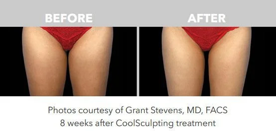 Comparison of thighs before and after CoolSculpting treatment, showing reduced fat and improved contour, eight weeks post-treatment.