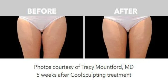 Comparison photos showing the thighs before and after CoolSculpting treatment, taken 5 weeks apart.