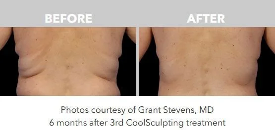 Comparison of a person's back showing before and after results of CoolSculpting treatment, 6 months apart.