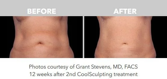 Side-by-side comparison of abdominal area before and after CoolSculpting treatment showing reduction in fat, with text indicating the photos are from Grant Stevens, MD, FACS, 12 weeks post-treatment.