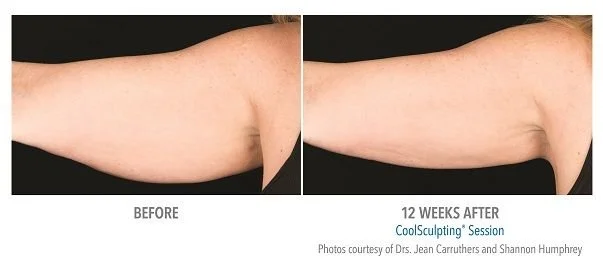 Side-by-side comparison of an arm showing a reduction in arm fat 12 weeks after a CoolSculpting session.
