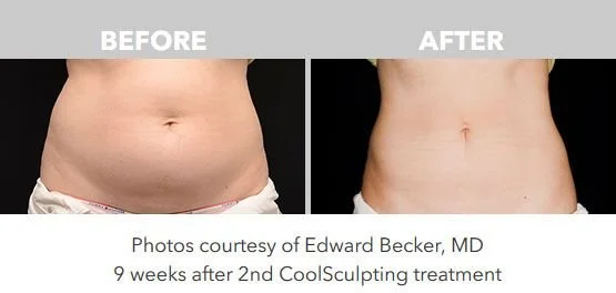 Side-by-side comparison of a person's abdomen before and after CoolSculpting treatment, showing a slimmer stomach after 9 weeks.