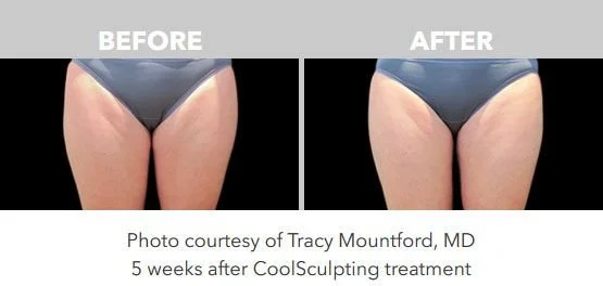 Comparison of thighs before and after CoolSculpting treatment, showing reduced fat in the after photo, taken five weeks post-treatment.