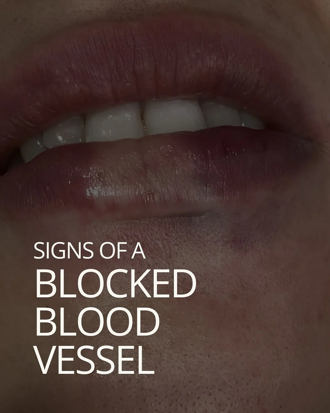 We&rsquo;re usually good at noticing when something doesn&rsquo;t feel right within our own bodies. 

And that matters as a medical aesthetics client, because when it comes to the days following a filler treatment, you play an active role in identify