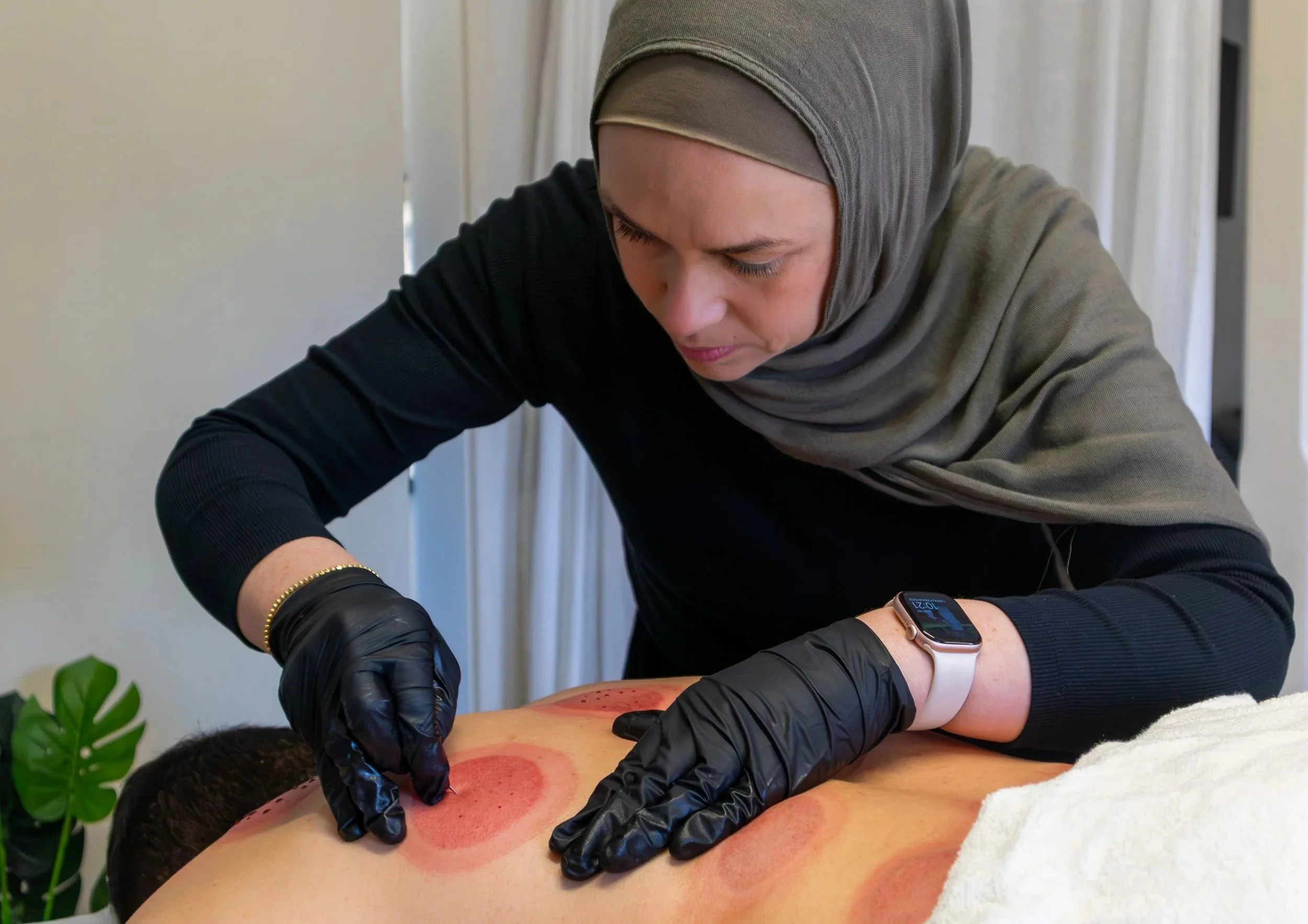 A woman in black gloves and a hijab performs cupping therapy on a person's back, which has visible circular cupping marks.