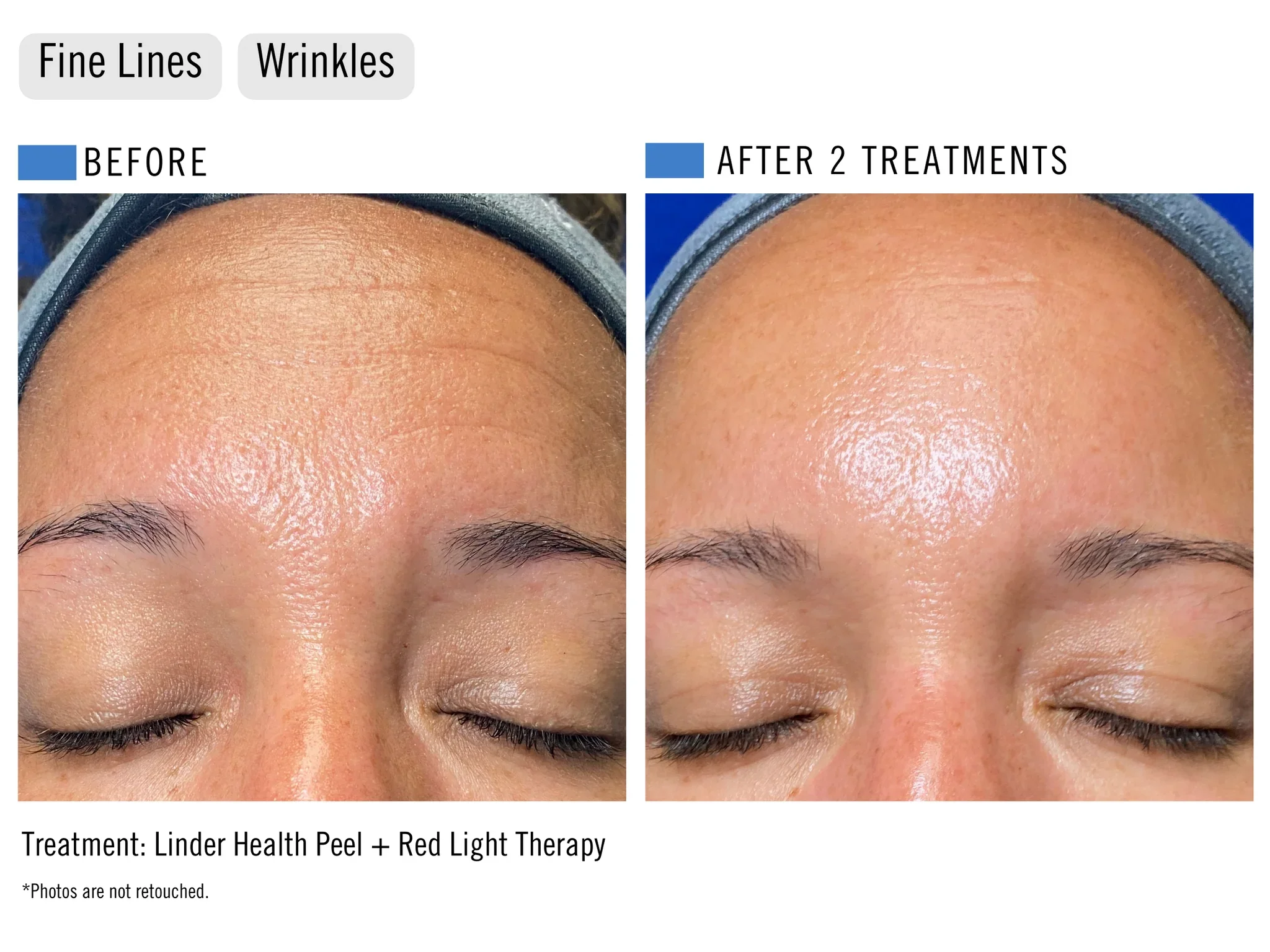 Comparison of a person's forehead before and after two treatments showing improved skin texture and reduced wrinkles, with labels indicating 'Before' and 'After 2 Treatments', at ILUMA Medical Spa in Monrovia.