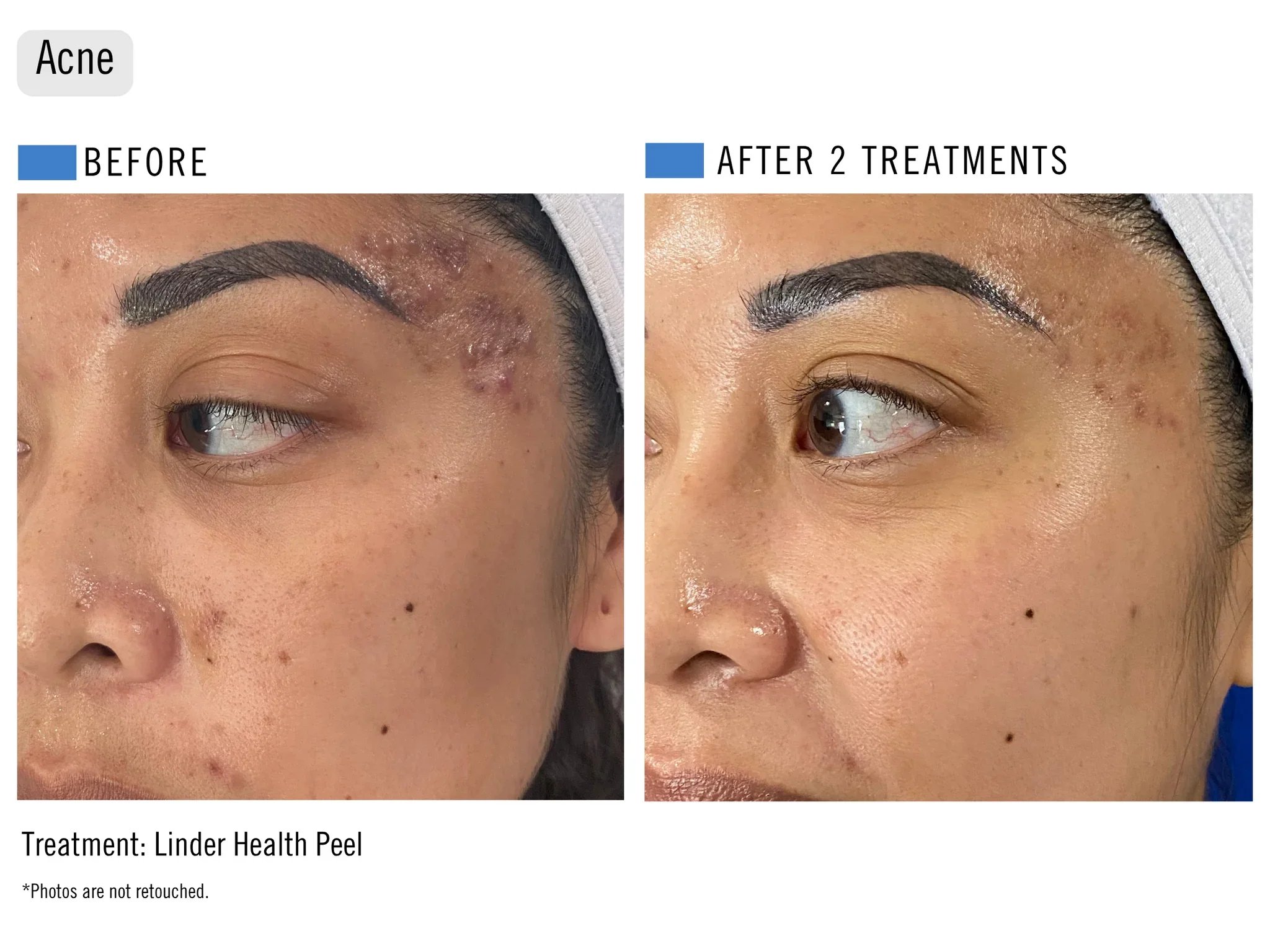 Before and after images of a person's face showing skin improvement after two treatments with a Lindar health peel, focusing on the cheek area with visible reduction in acne and skin scars, at ILUMA Medical Spa in Monrovia.