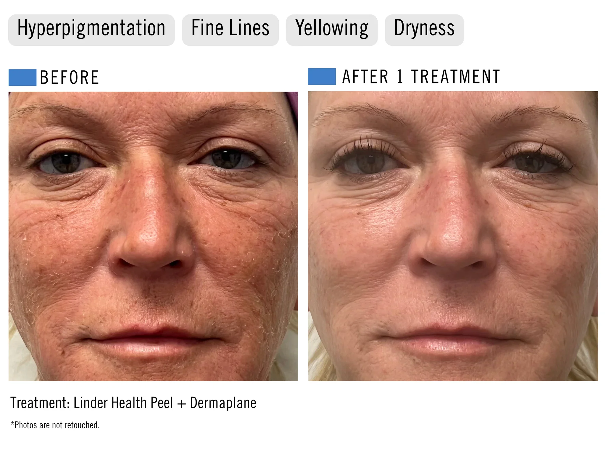 Side-by-side before and after photos of a woman's face at ILUMA Medical Spa in Monrovia showing improved skin after Linder Health Peel and Dermaplane: before had hyperpigmentation, fine lines, and dry skin; after is smoother, brighter, and even.