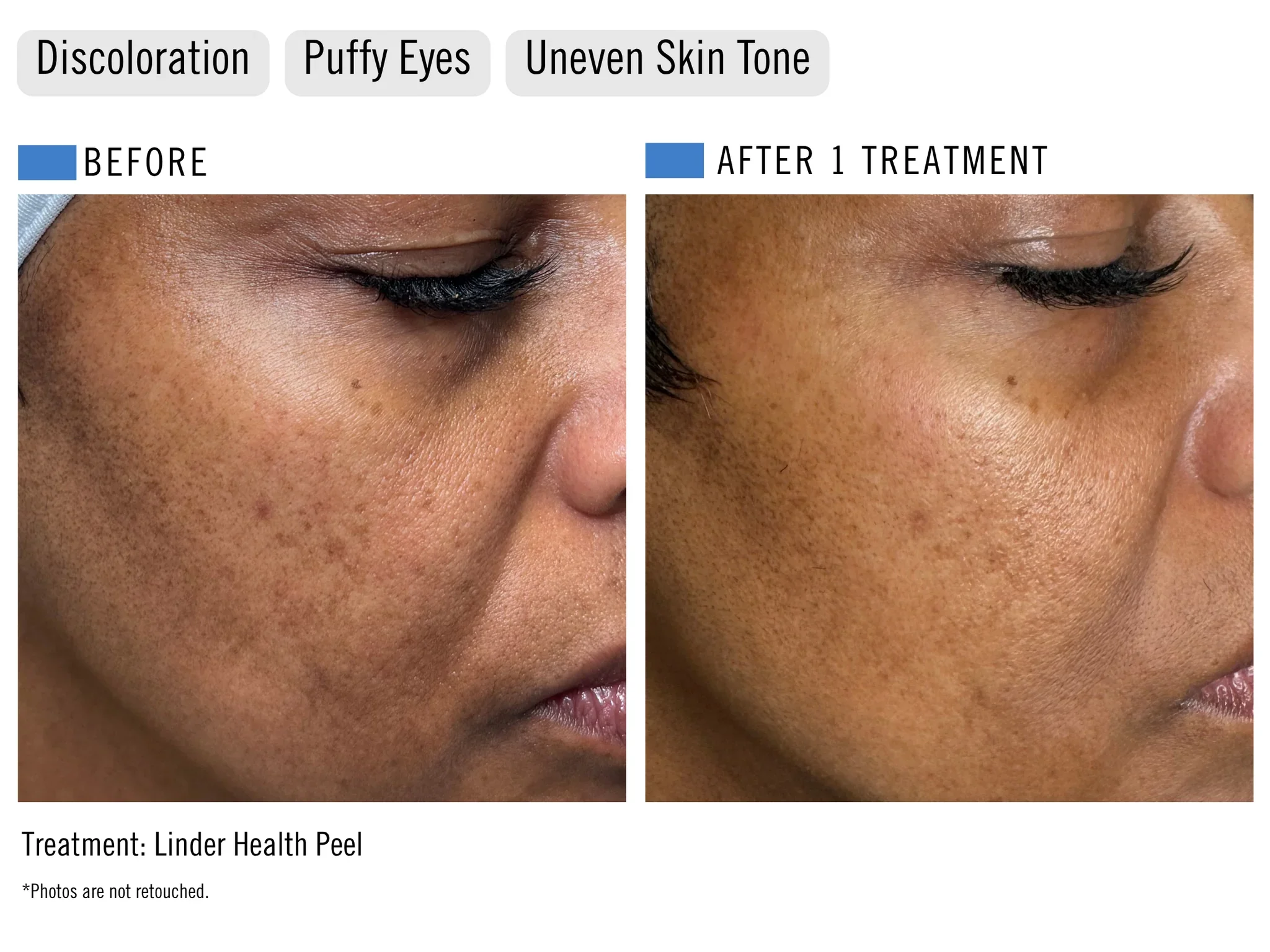 Before and after comparison of cheek and eye area showing improvement after one Linder Health Peel treatment at ILUMA Medical Spa in Monrovia, with reduced discoloration, puffy eyes, and uneven skin tone.