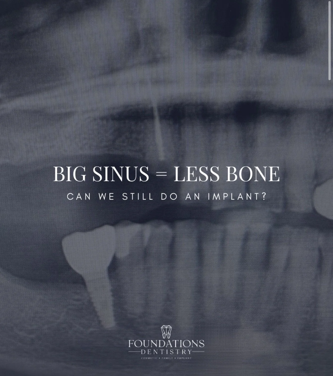 Dental Implants Without Sinus Grafting — Is It Possible?