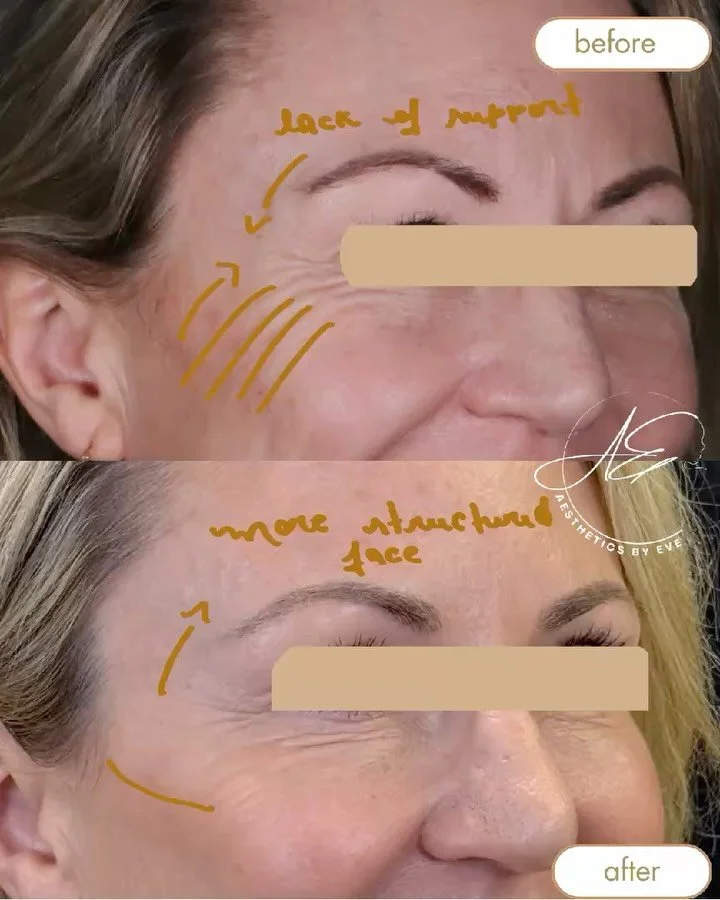 When it comes to facial rejuvenation, not all volume loss happens in the same place, and not all fillers go into the middle cheek.
Our facial structure relies on multiple “support pillars.”
When the lateral cheek, the outer portion of th