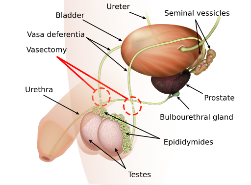 Diagram of the male reproductive and urinary system showing the bladder, ureter, seminal vesicles, prostate, bulbourehtral gland, epididymides, testes, urethra, vas deferentia, and vasectomy.