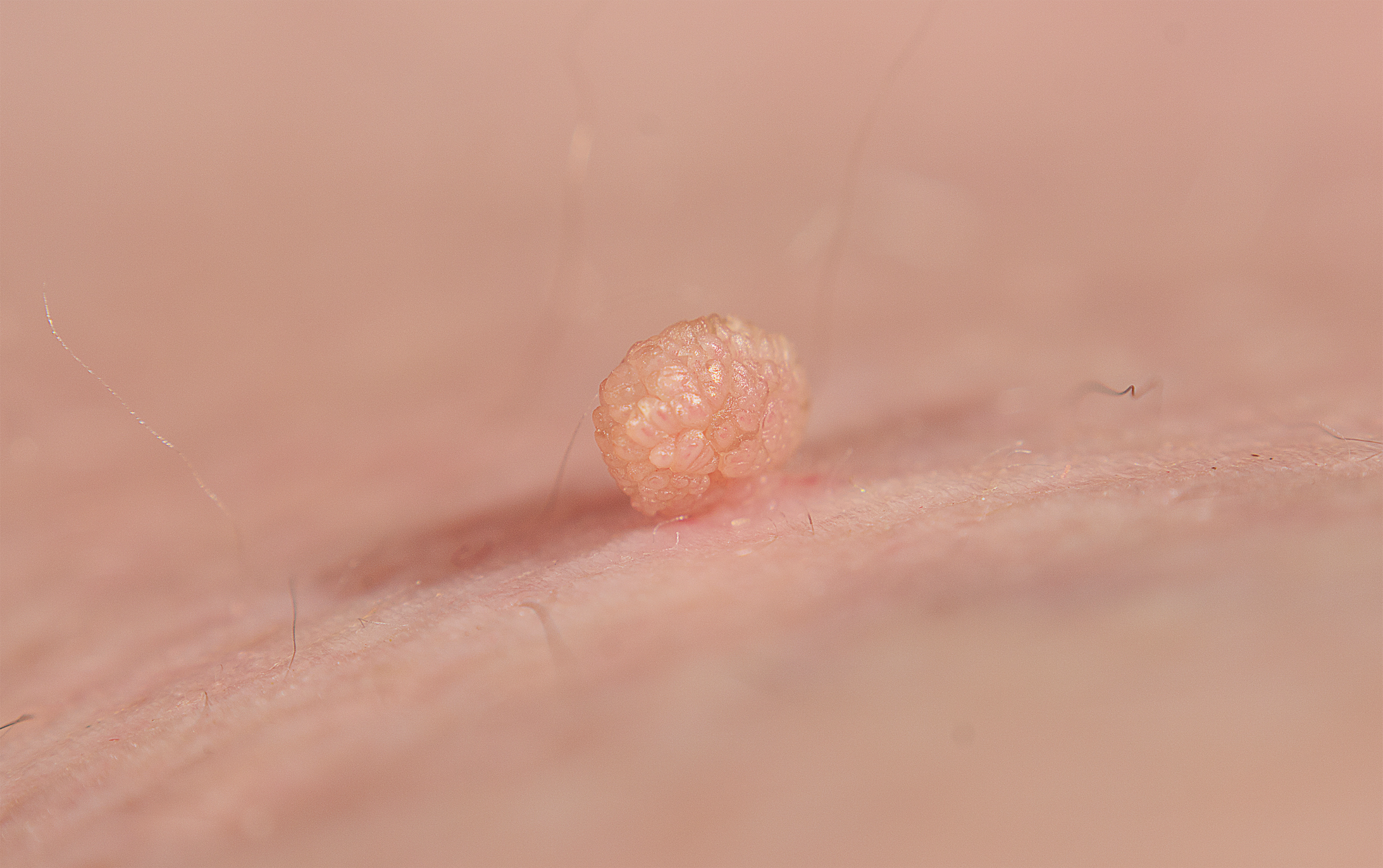 skin tag copy.png