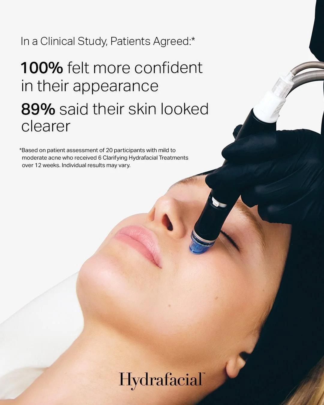 Now available at beauteous!
HydraFacial is a popular skin treatment that deeply cleanses, exfoliates, removes impurities from pores, and infuses the skin with nourishing serums in one treatment with no downtime.
It helps improve dullness, clogged por
