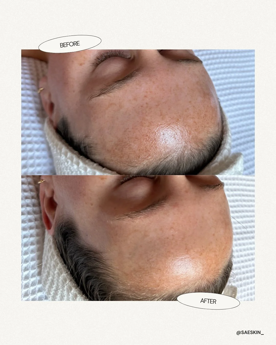 Before and after just one gentle peel treatment 🤍

This beautiful bride to be came in hoping to brighten her complexion and lighten the melasma across her forehead before her November wedding. With the big day approaching, we were definitely on a bi