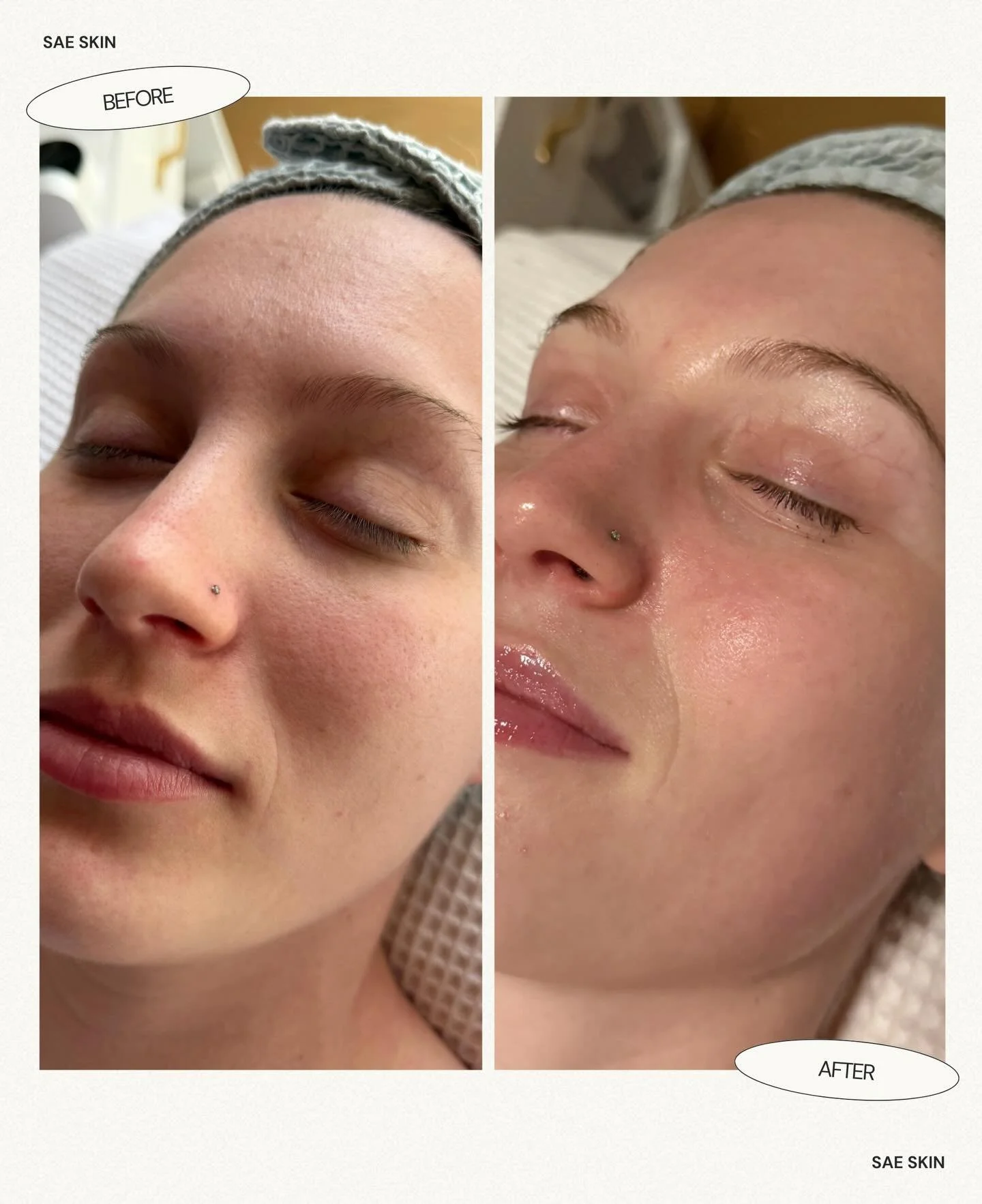 Before &rarr; after: this is her skin on her fourth visit with me 🤍

We started working together at the beginning of October, coming in once a month and staying consistent with a personalized home care routine in between.

When she first came in, he