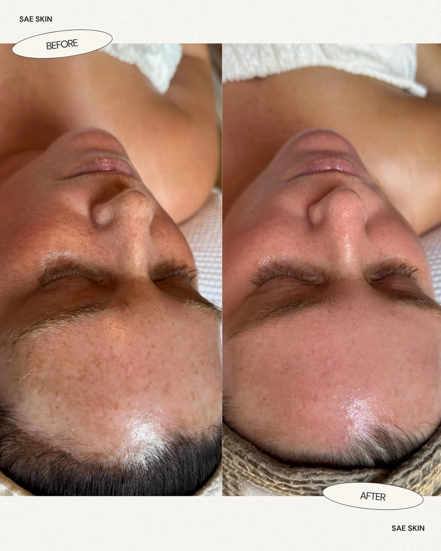 This is your reminder that real results don&rsquo;t happen overnight! Her goal was to even out her tone and over the past 5 months we&rsquo;ve focused on consistent, barrier-first skin correction, supporting her skin without overworking it, along wit