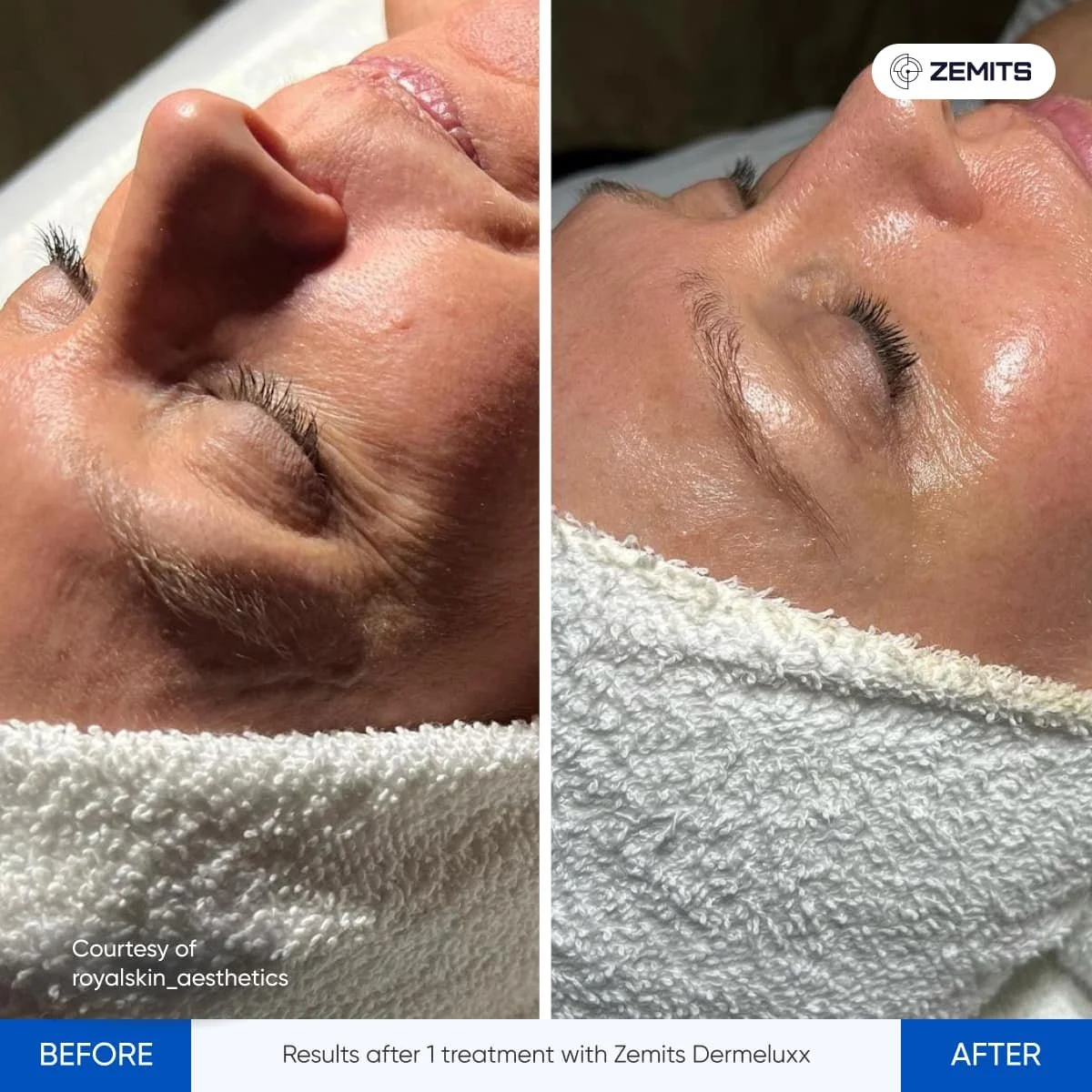 Side-by-side comparison of a person's face before and after skin treatment, showing improved skin texture and appearance after one treatment with Zemits Dermeluxx.