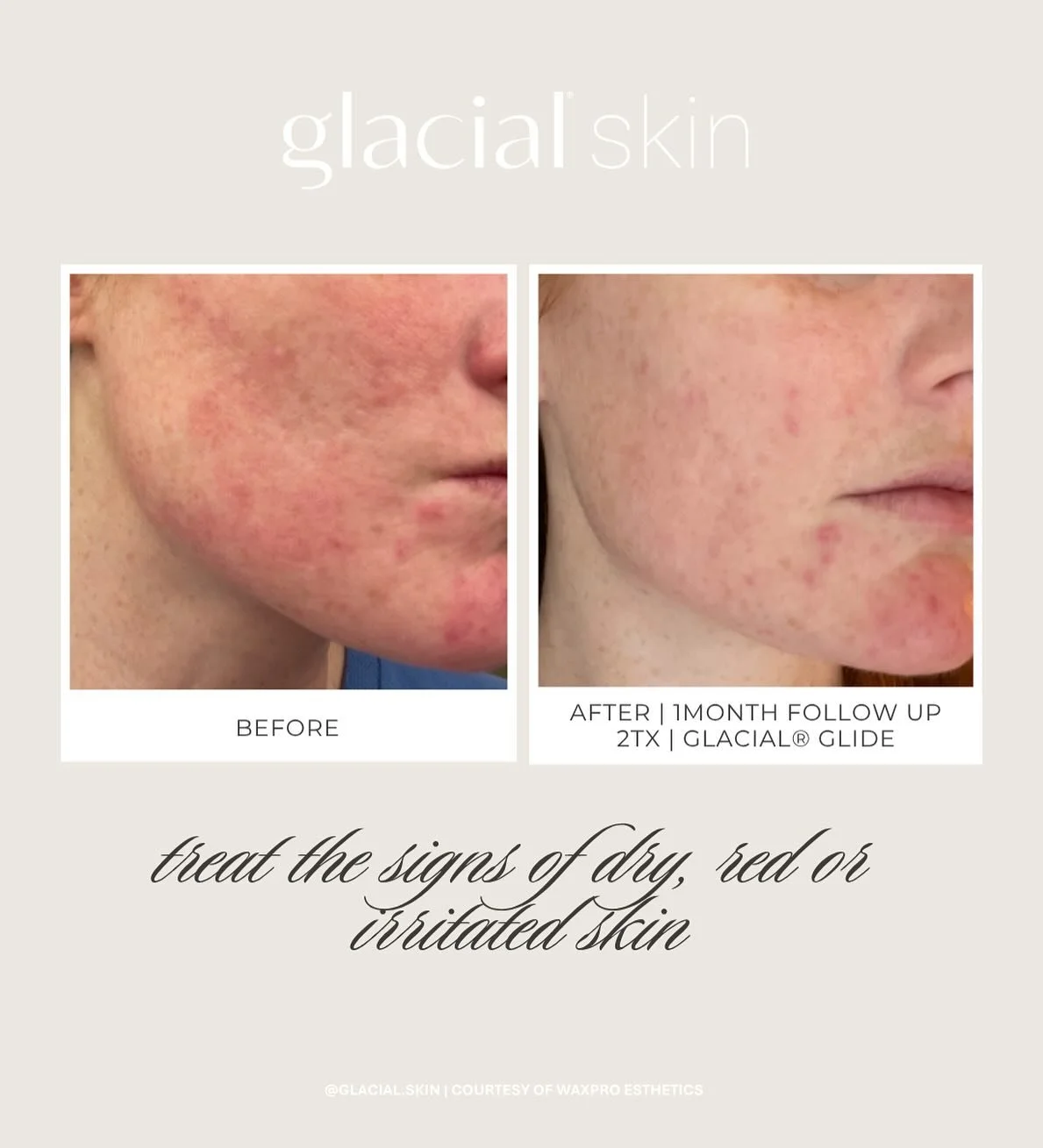 #skinflammation 

Stop struggling with dry, red &amp; irritated skin&mdash;

We have a solution for YOU! 

Glacial Skin Facial calling your skin to the treatment room 📞 

Let&rsquo;s go! Book your consultation today! 

www.skinintentionsandwellness.
