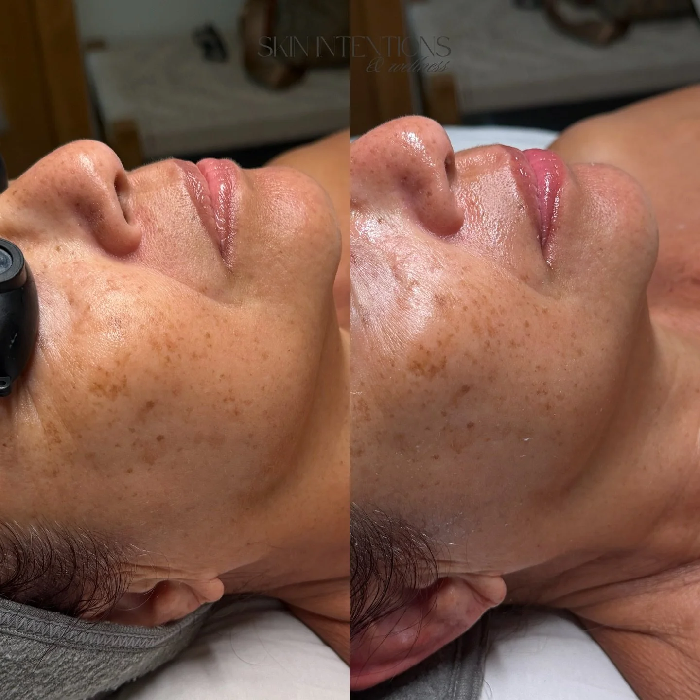 Aging isn&rsquo;t just about wrinkles&mdash;it&rsquo;s about inflammation.

As we age, our skin becomes more prone to chronic, low-grade inflammation (often called inflammaging). This silent stress breaks down collagen, weakens the skin barrier, and 