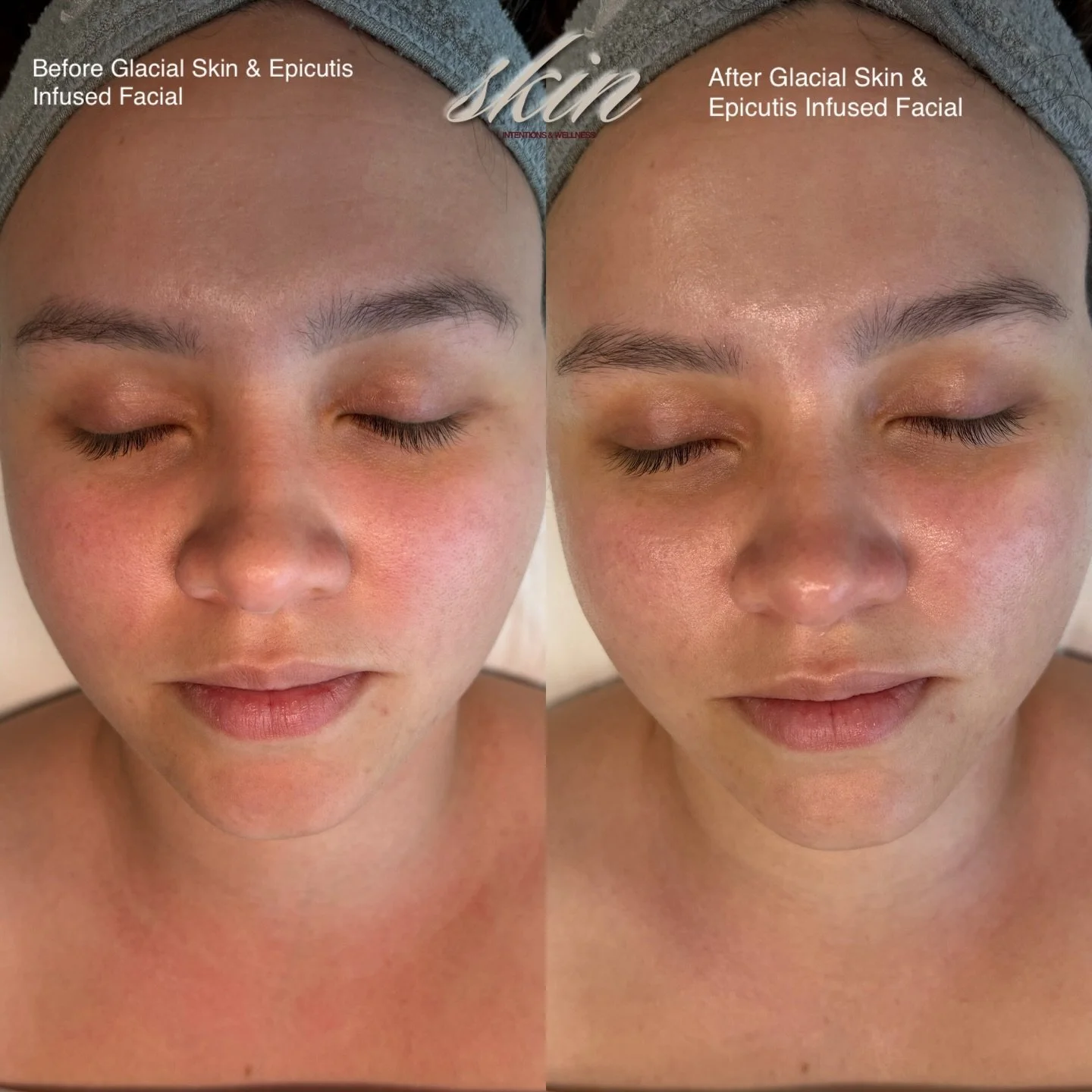 Powered by Epicutis + our Glacial Skin Facial ✨

This treatment is all about calming before correcting.

Epicutis focuses on skin barrier repair, deep hydration, and reducing inflammation at a cellular level&mdash;making it the perfect partner for ou