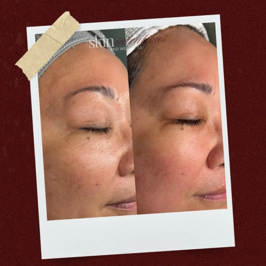 🚀 this client has completed 3 Procell Microchanneling Treatments

Procell Microchanneling treatments is a staple at Skin Intentions and Wellness because of the results that it continues to deliver 

Procell Therapies isn&rsquo;t just your average sk