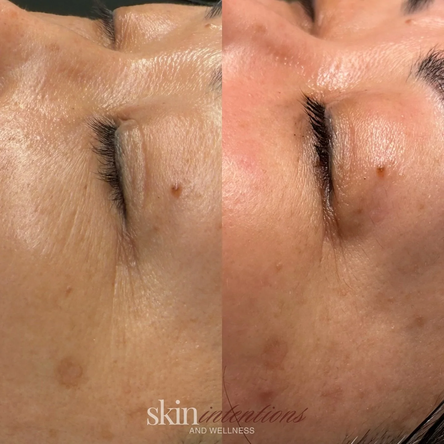 before > after Procell Microchanneling Treatments 

👀look at those B+A of her under eyes!

my clients concerns were to correct the fine lines under her eyes and I&rsquo;m happy to say we have helped smooth, tighten and brighten the area 

Procell