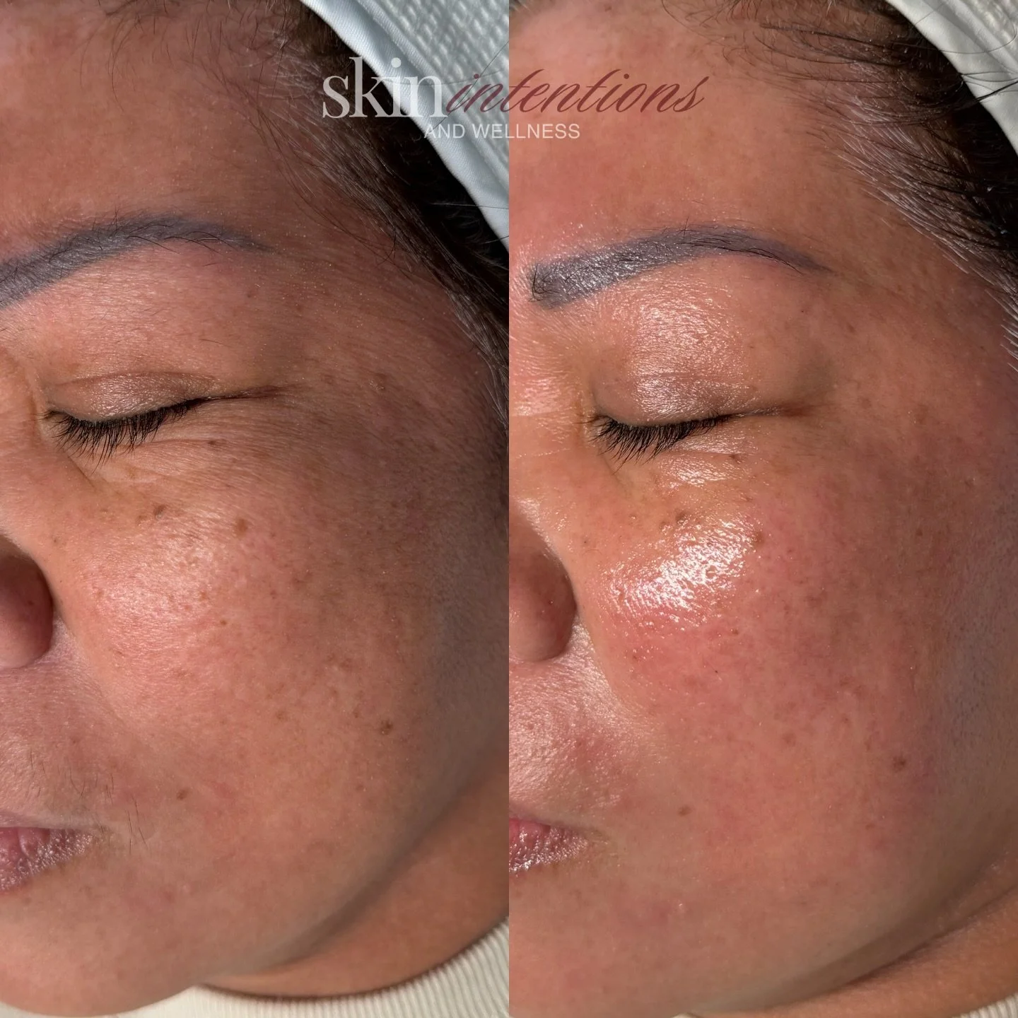 we love a good before and after ✨

post hydrodiamond express facial + dermaplaning add on

instant results: physical exfoliation, smoother, brighter, hydrated, plump, and glowy skin

this service is for you if you are tired of your dull and dry skin 