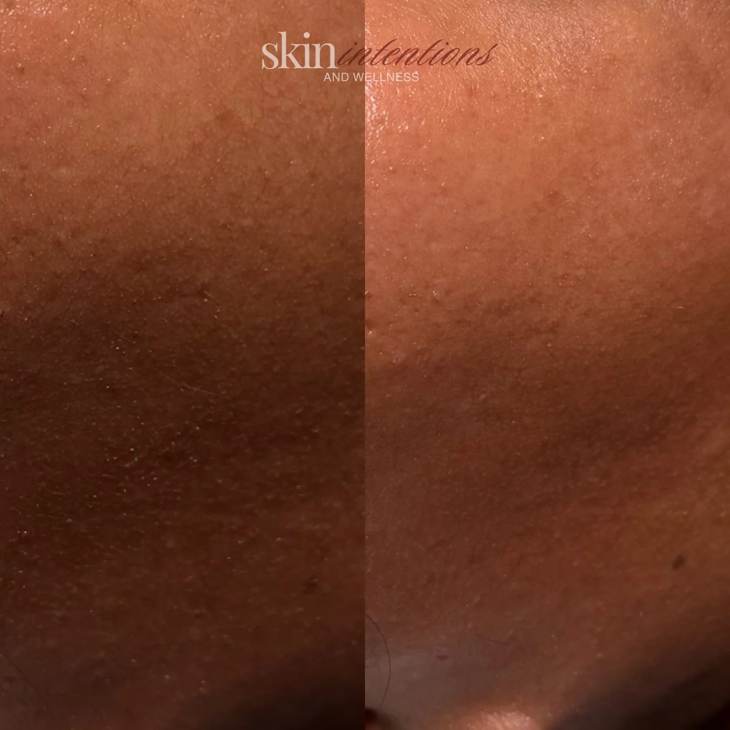 have you experienced dry, flaky and textured skin?
you can visibly see dead skin cells on the surface of the skin in the left photo

the right photo shows the results after receiving an oxygen peel and dermaplaning. 

dead skin cells are no longer vi
