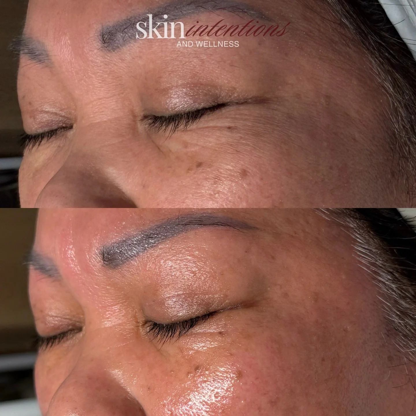 hydration is the foundation of healthy, glowing skin 

one of my favorite transformations&mdash;instantly smoother, brighter, and more radiant skin.

✨ before: dull, dry, textured 
✨ after: soft, hydrated, glowing 

every facial is customized to your