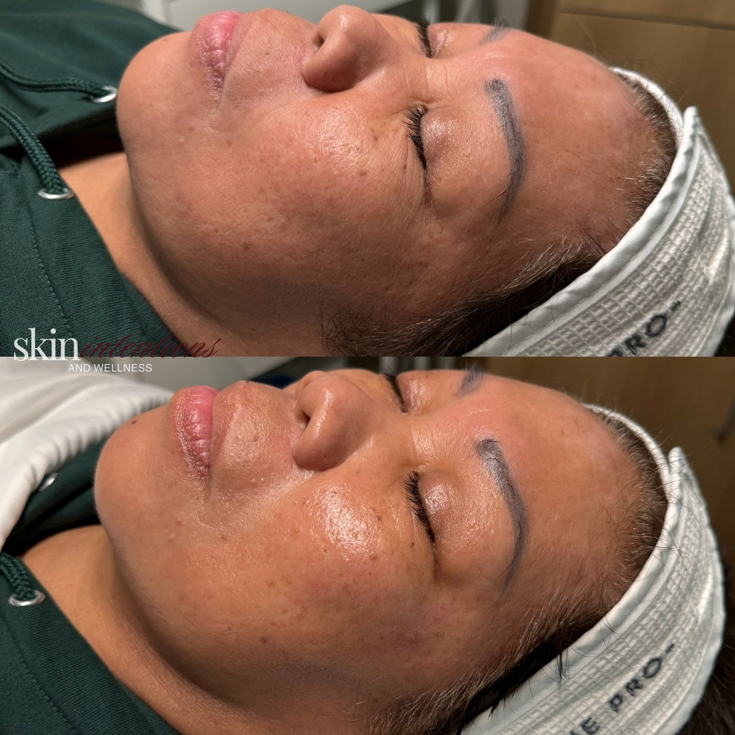 How she came in (top)
How she left (bottom) 😘

What incredible results with the Glacial Skin Facial 

Glacial Skin is one of our favorite treatments because the transformation is immediate

Why we love it:
&bull; Instantly cools and calms inflammati