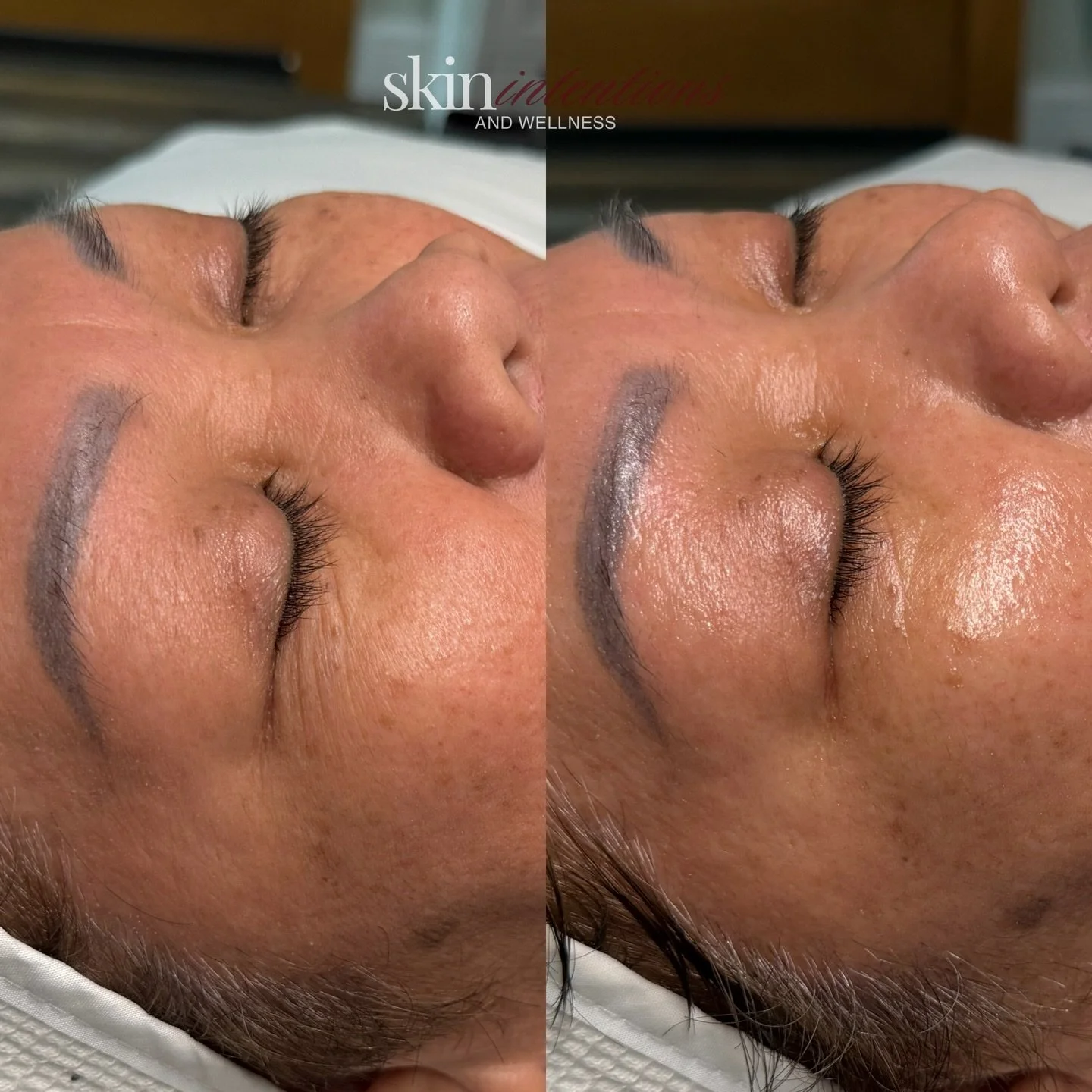 the ultimate skin rejuvenation&mdash; instantly after a glacial skin facial 

 💕❄️